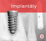 implantaty